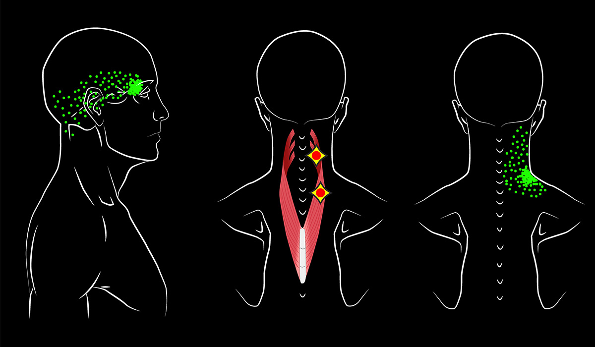 例えば、肩こりから始まる痛みが、首や頭にまで広がり、結果的に頭痛を引き起こすような痛みがトリガーポイントに起因する疼痛になります。